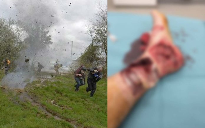 Le cri d’alarme d’un belge blessé en France par une grenade GLI-F4