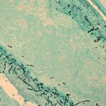 606px-Dpk-meningitis-fungus-in-brain